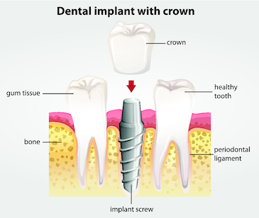 Dental Implants