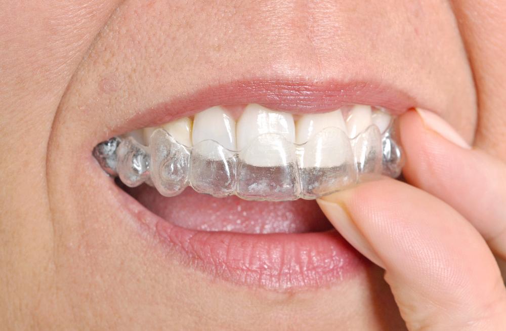 Transparent Aligners