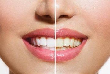 teeth before and after dental care seymour tn