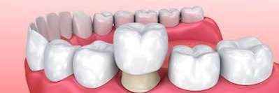 dental crowns seymour tn
