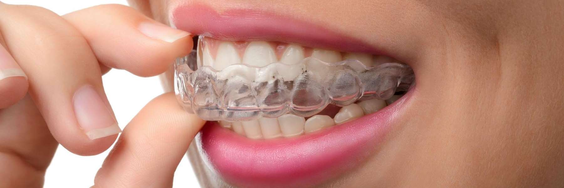 woman holding clear aligners in her mouth